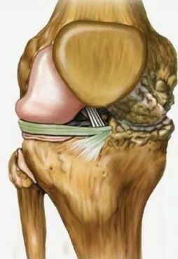 Kniegelenks -Osteoarthritis