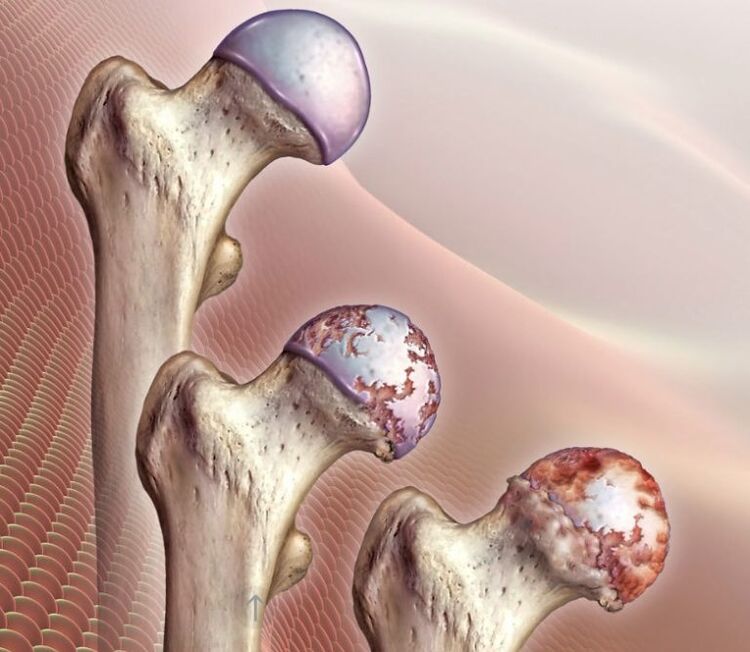 Hüftgelenk -Osteoarthritis