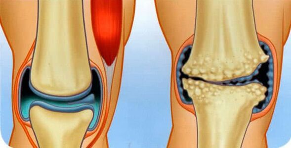 Der normale Zustand des Gelenks und die Ursachen für die Entwicklung der Arthrose des Knies