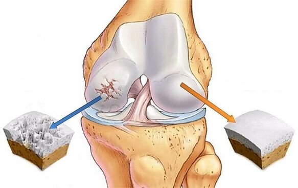 Standard und Abweichung für Arthrose des Kniegelenks
