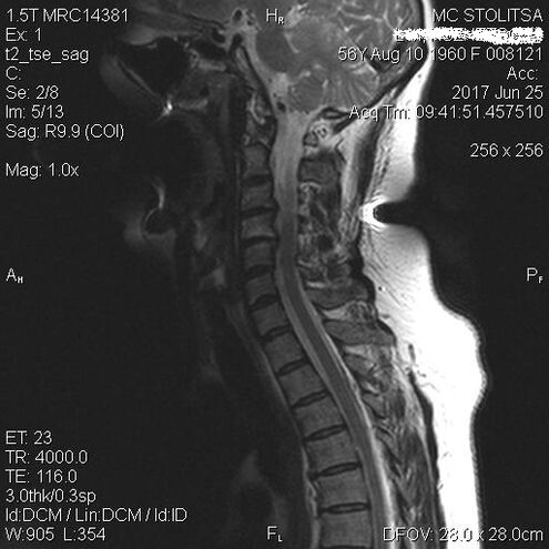 Osteochondrose und Spondyose der Halsspalte