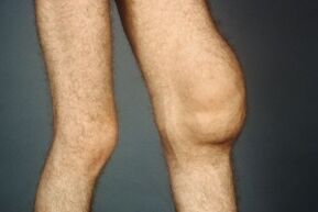 Die Ursachen und Symptome der Arthrose des Kniegelenks