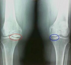 Das Ergebnis der Behandlung von Arthritis und der beliebten Rechtsmittel der Arthrose