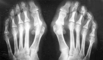 Differentialdiagnose von Symptomen von Arthritis und Arthrose