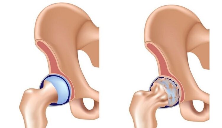 Gesund und artikuliert mit Arthrose