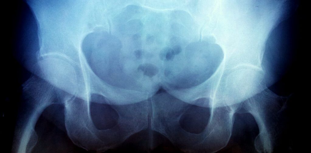 X -RAY -Bild mit Arthritis zweiten Grades